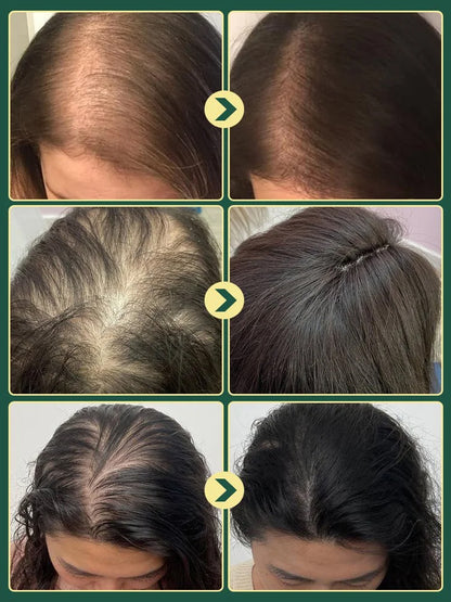 ⭐[The less hair, the better the effect] Herbal Essence Nourishing Repair Shampoo.👩‍⚕️Doctor-recommended! Formulated for thinning hair and severe hair loss.🌿Infused with rosemary + cinnamon extract—even bald spots grow new hair!